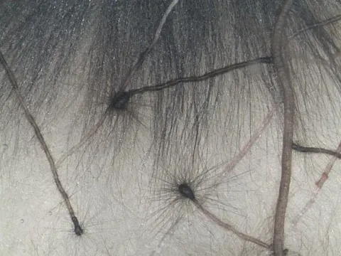 Cenococcum