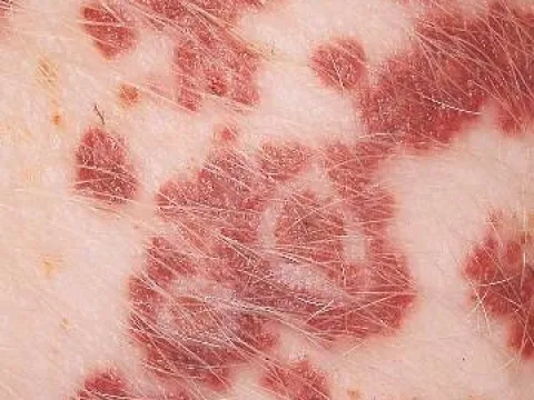 Swine Erysipelas