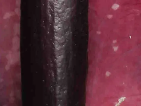 Dracunculus